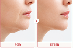 Brightskin PoreReset™ - behandling for hudormer og synlige porer 4-pakning